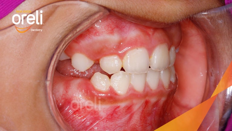 Niềng chỉnh cắn ngược lúc 9 tuổi lúc chưa mọc đủ răng ở nha khoa Oreli
