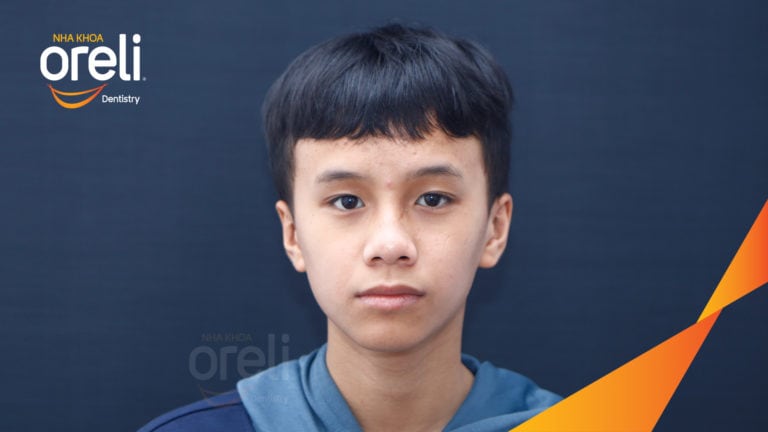 Ca niềng chỉnh lệch cằm kết quả sau 2 năm tại Oreli