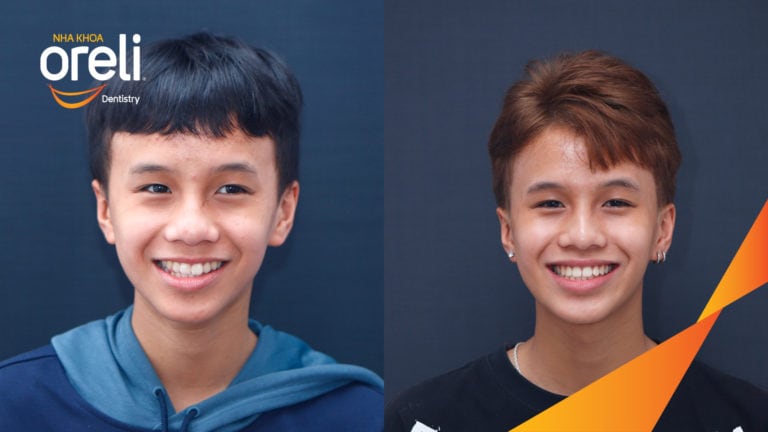 nieng rang chinh lech cam