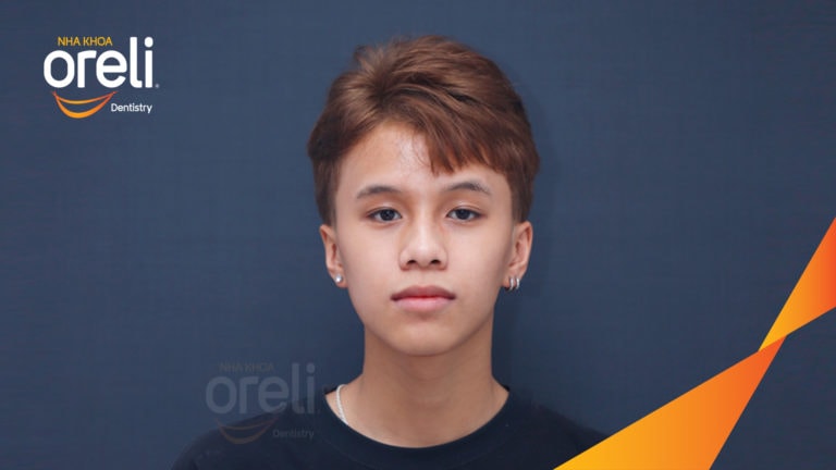 Ca niềng chỉnh lệch cằm kết quả sau 2 năm tại Oreli