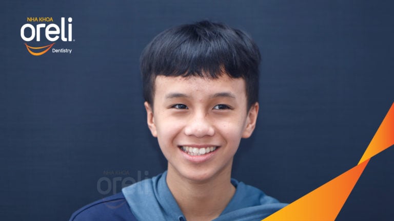 Ca niềng chỉnh lệch cằm kết quả sau 2 năm tại Oreli