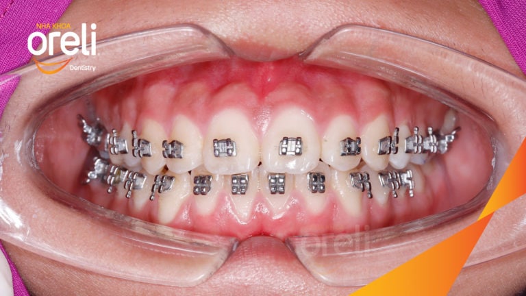 Ca niềng chỉnh lệch cằm kết quả sau 2 năm tại Oreli