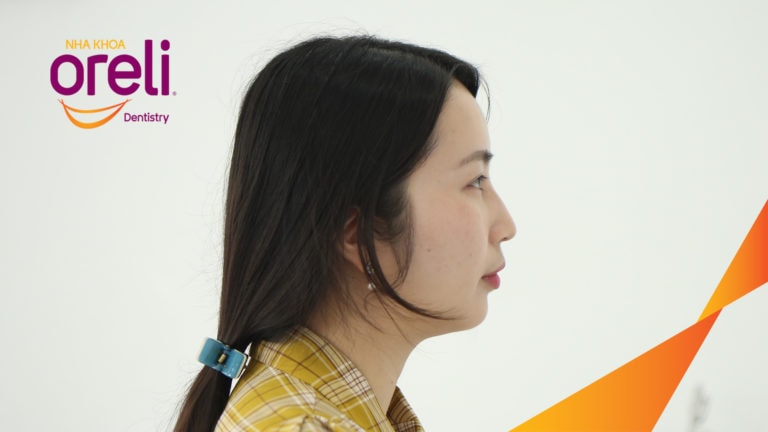 Ca niềng răng sai khớp cắn hạng 2 chi 2 kết quả sau hơn 2 năm tại Oreli