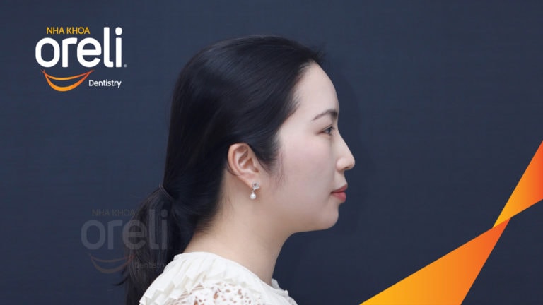 Ca niềng răng sai khớp cắn hạng 2 chi 2 kết quả sau hơn 2 năm tại Oreli