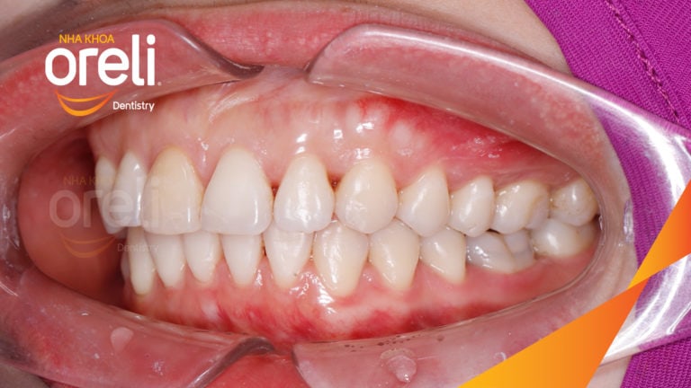 Ca niềng răng sai khớp cắn hạng 2 chi 2 kết quả sau hơn 2 năm tại Oreli