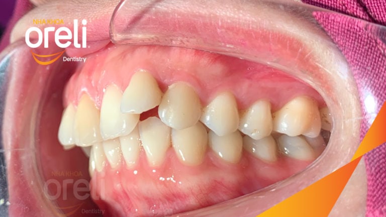 Ca niềng răng sai khớp cắn hạng 2 chi 2 kết quả sau hơn 2 năm tại Oreli