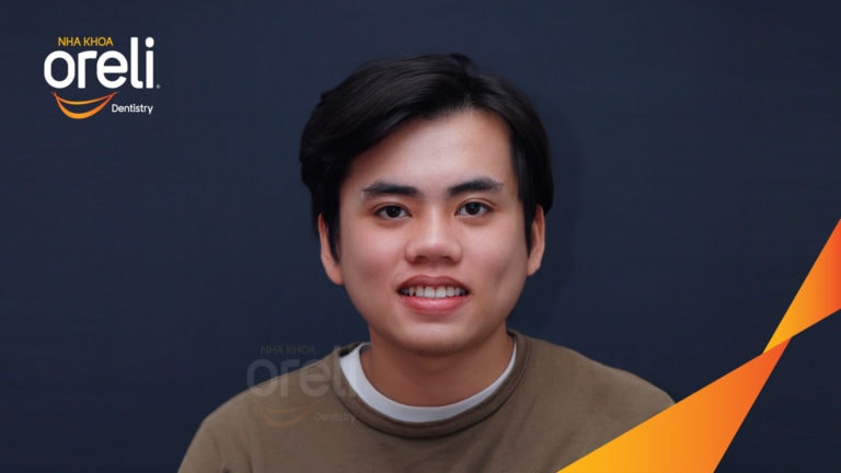 Ca niềng kéo răng nanh ngầm lạc chỗ kết quả sau 24 tháng tại nha khoa Oreli