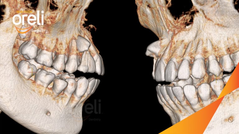 Ca niềng kéo răng nanh ngầm lạc chỗ kết quả sau 24 tháng tại nha khoa Oreli
