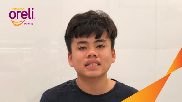 Ca niềng kéo răng nanh ngầm lạc chỗ kết quả sau 24 tháng tại nha khoa Oreli
