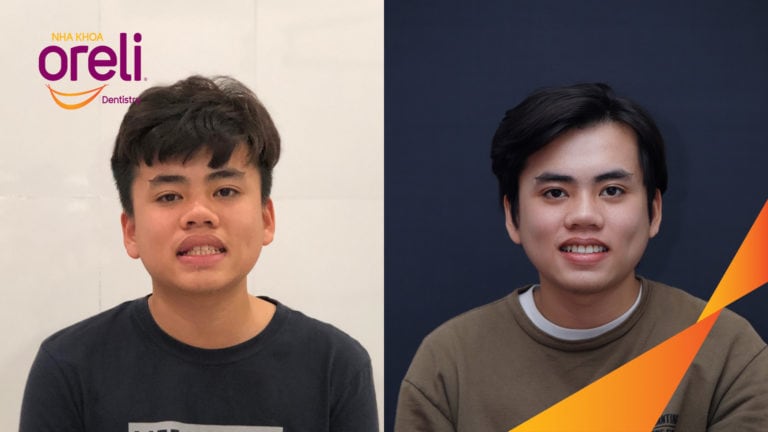 nieng rang keo rang nanh lac cho nha khoa oreli bmt