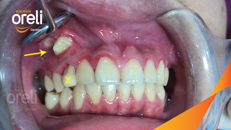 Ca niềng kéo răng nanh ngầm lạc chỗ kết quả sau 24 tháng tại nha khoa Oreli