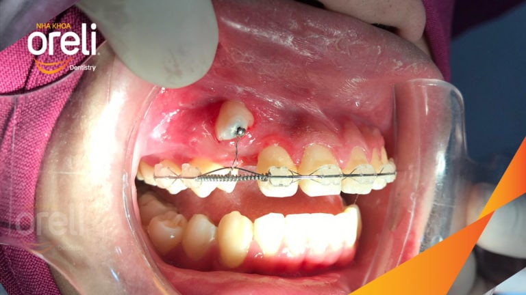 Ca niềng kéo răng nanh ngầm lạc chỗ kết quả sau 24 tháng tại nha khoa Oreli