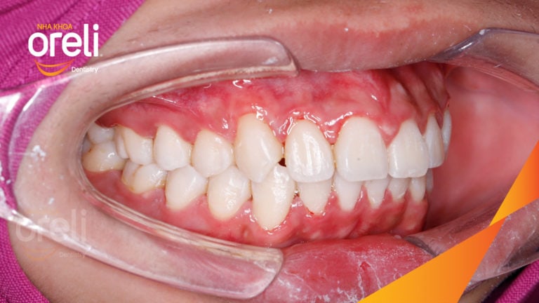 Ca niềng kéo răng nanh ngầm lạc chỗ kết quả sau 24 tháng tại nha khoa Oreli