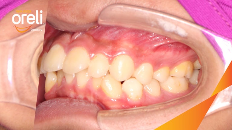 Ca niềng chỉnh cắn sâu không nhổ răng kết quả cười đẹp sau hơn hai năm tại Oreli