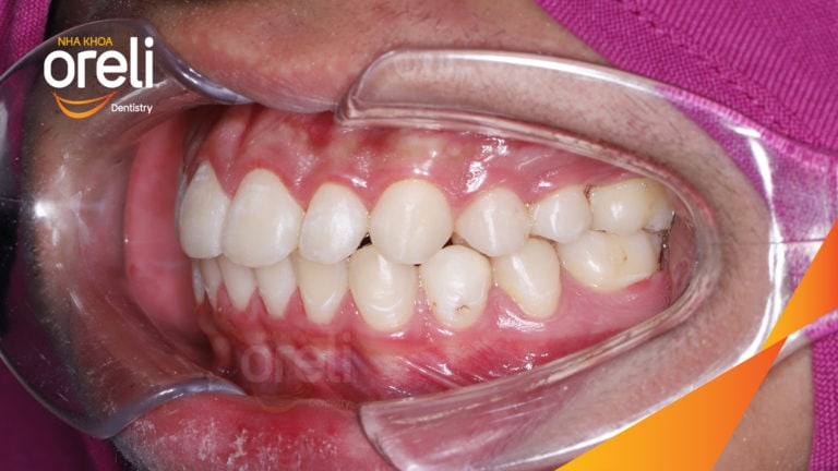 Ca niềng chỉnh cắn sâu không nhổ răng kết quả cười đẹp sau hơn hai năm tại Oreli