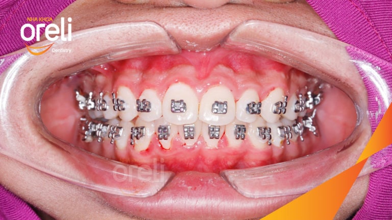 Ca niềng chỉnh cắn sâu không nhổ răng kết quả cười đẹp sau hơn hai năm tại Oreli