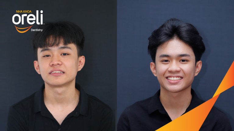 nieng rang chinh can sau o bmt