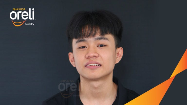 Ca niềng chỉnh cắn sâu không nhổ răng kết quả cười đẹp sau hơn hai năm tại Oreli