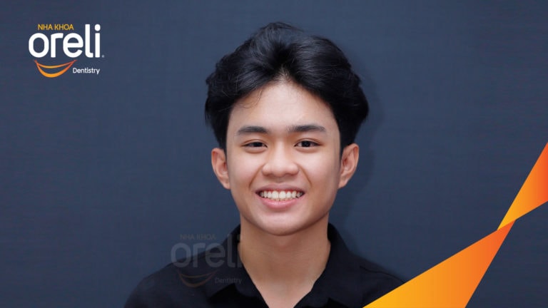 Ca niềng chỉnh cắn sâu không nhổ răng kết quả cười đẹp sau hơn hai năm tại Oreli