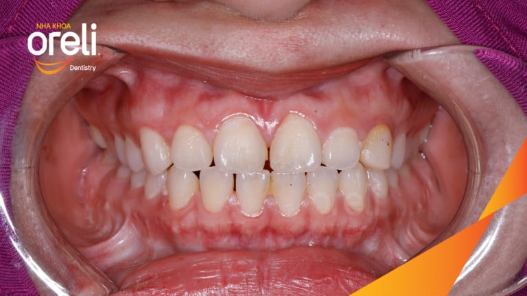 Ca niềng khe thưa bằng mắc cài sứ kết quả thay đổi sau 18 tháng tại nha khoa Oreli