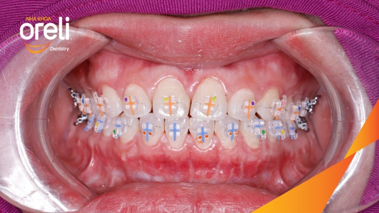 Ca niềng khe thưa bằng mắc cài sứ kết quả thay đổi sau 18 tháng tại nha khoa Oreli