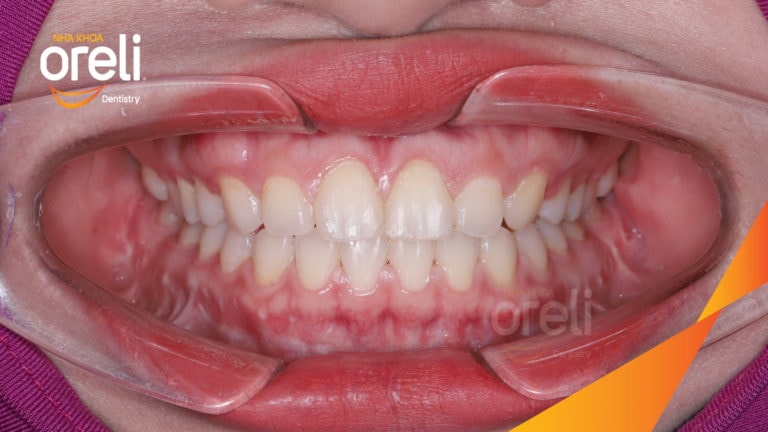 Ca niềng khe thưa bằng mắc cài sứ kết quả thay đổi sau 18 tháng tại nha khoa Oreli
