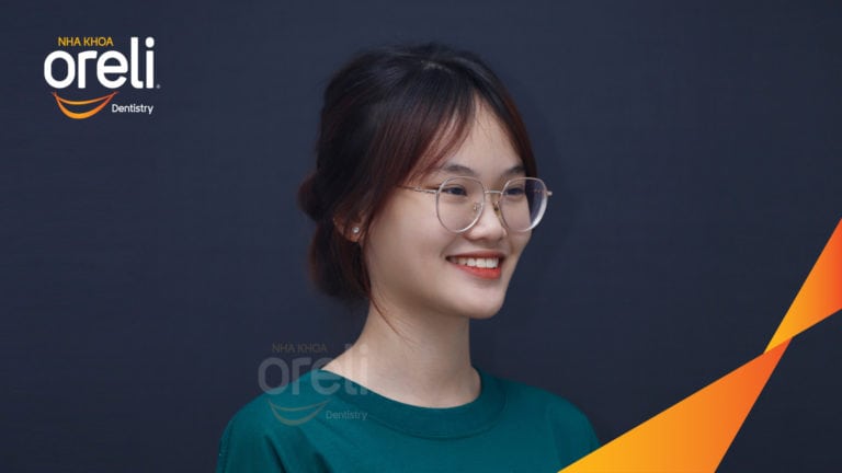 Ca niềng răng sai khớp cắn hạng 3 móm răng chen chúc điều trị tại Oreli