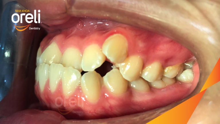 Ca niềng răng sai khớp cắn hạng 3 móm răng chen chúc điều trị tại Oreli