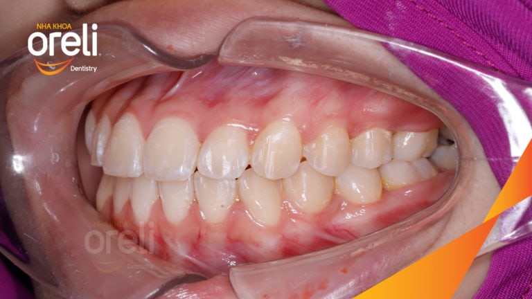 Ca niềng răng sai khớp cắn hạng 3 móm răng chen chúc điều trị tại Oreli