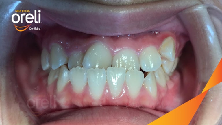 Ca niềng răng sai khớp cắn hạng 3 móm răng chen chúc điều trị tại Oreli