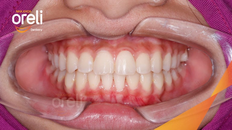 Ca niềng răng chen chúc không nhổ răng kết quả sau 24 tháng tại Oreli