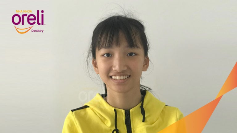 Ca niềng răng chen chúc không nhổ răng kết quả sau 24 tháng tại Oreli