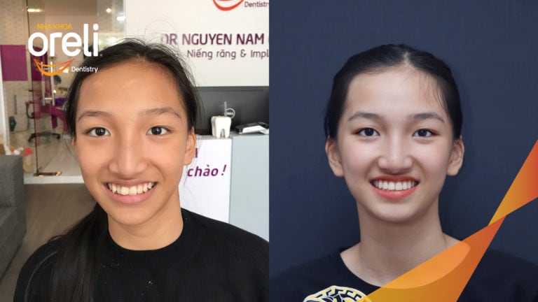 nieng rang khong nho rang oreli bmt bs chung