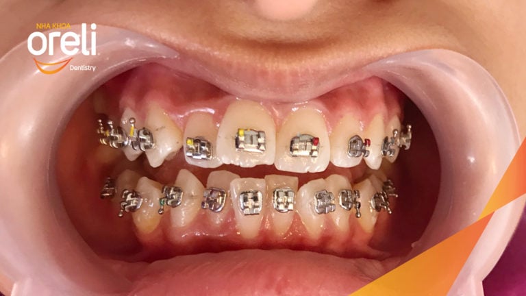 Ca niềng răng chen chúc không nhổ răng kết quả sau 24 tháng tại Oreli