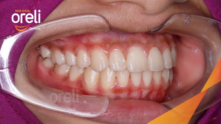 Ca niềng răng chen chúc không nhổ răng kết quả sau 24 tháng tại Oreli