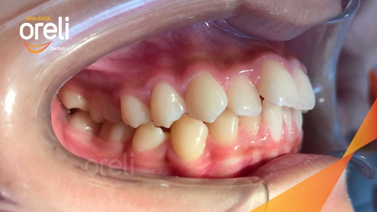 Ca niềng răng chen chúc không nhổ răng kết quả sau 24 tháng tại Oreli