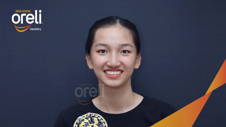 Ca niềng răng chen chúc không nhổ răng kết quả sau 24 tháng tại Oreli