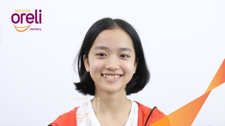 Niềng răng móm hạng 3 không phẫu thuật – Case thực tế tại Oreli