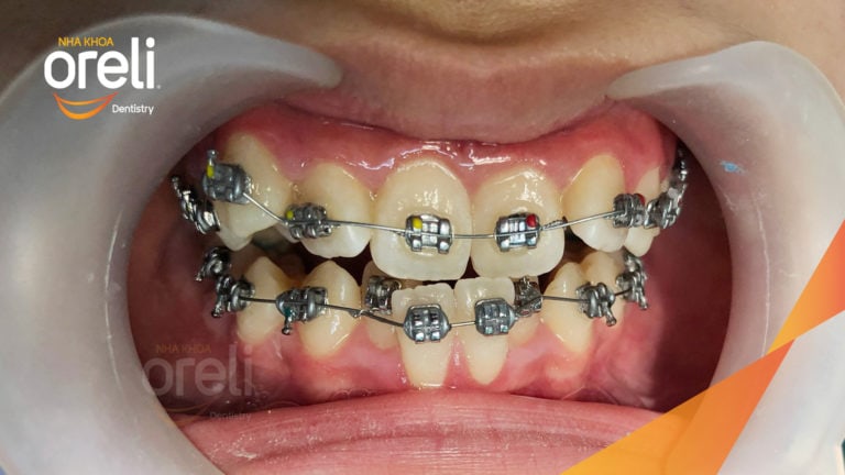 Niềng răng móm hạng 3 không phẫu thuật – Case thực tế tại Oreli