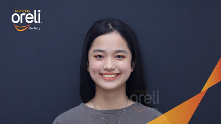 Niềng răng móm hạng 3 không phẫu thuật – Case thực tế tại Oreli
