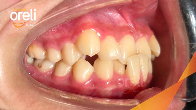 Niềng răng móm hạng 3 không phẫu thuật – Case thực tế tại Oreli
