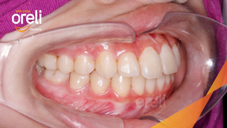 Niềng răng móm hạng 3 không phẫu thuật – Case thực tế tại Oreli