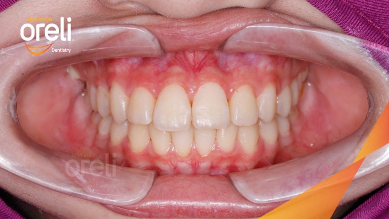 Niềng răng móm hạng 3 không phẫu thuật – Case thực tế tại Oreli