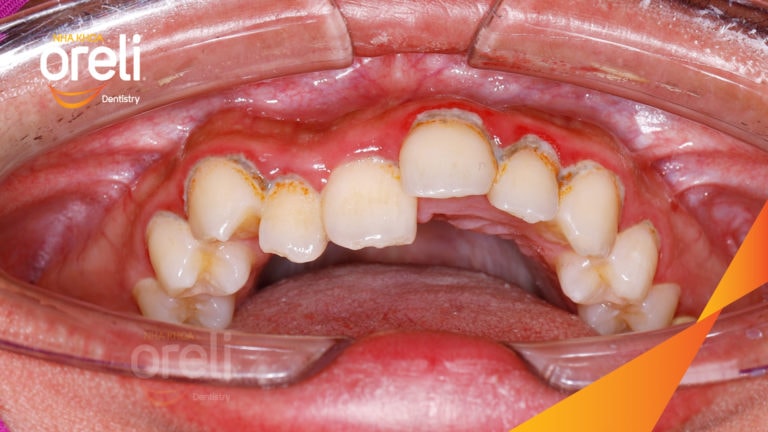 Ca niềng chỉnh cắn ngược răng cửa hàm trên kết quả thực tế tại Oreli