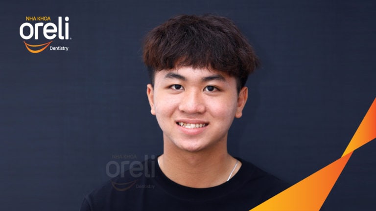 Ca niềng chỉnh cắn ngược răng cửa hàm trên kết quả thực tế tại Oreli