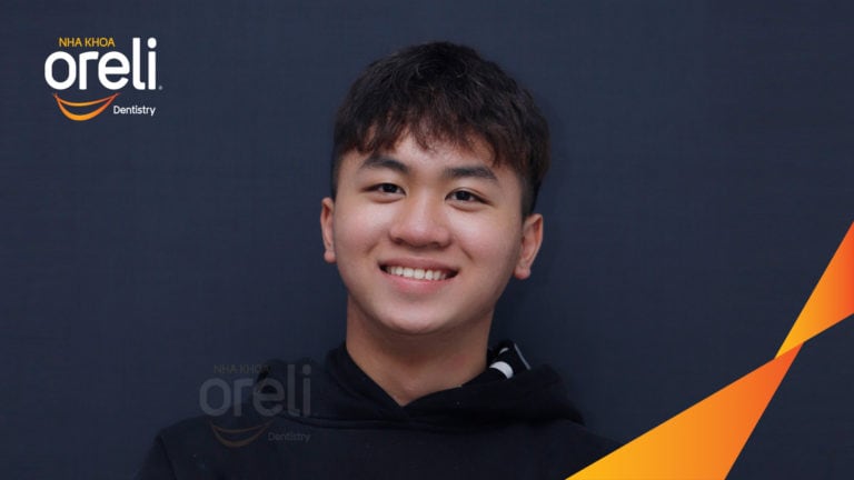 Ca niềng chỉnh cắn ngược răng cửa hàm trên kết quả thực tế tại Oreli