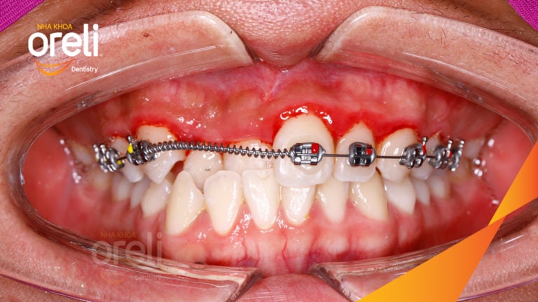 Ca niềng chỉnh cắn ngược răng cửa hàm trên kết quả thực tế tại Oreli