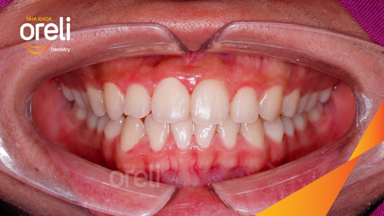 Ca niềng chỉnh cắn ngược răng cửa hàm trên kết quả thực tế tại Oreli