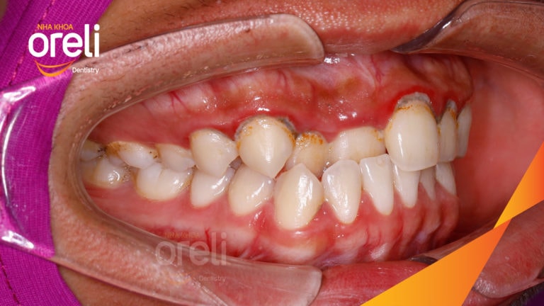 Ca niềng chỉnh cắn ngược răng cửa hàm trên kết quả thực tế tại Oreli