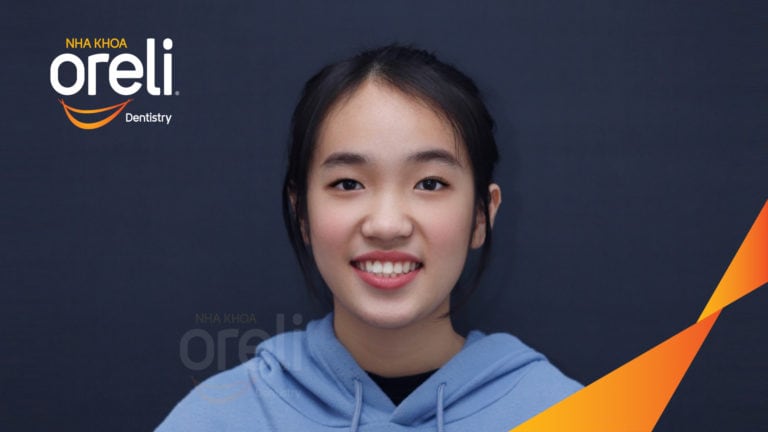 Niềng kéo hai răng ngầm kết quả sau hơn hai năm tại nha khoa Oreli